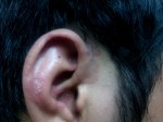 Nấm da vành tai